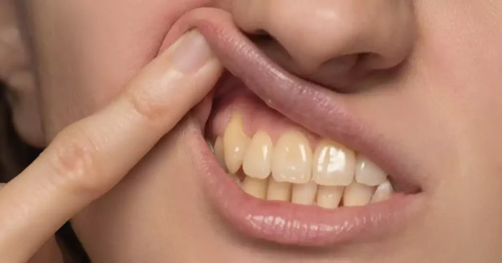 Diş Eti Çekilmesi Nedir? Belirtileri Nelerdir?