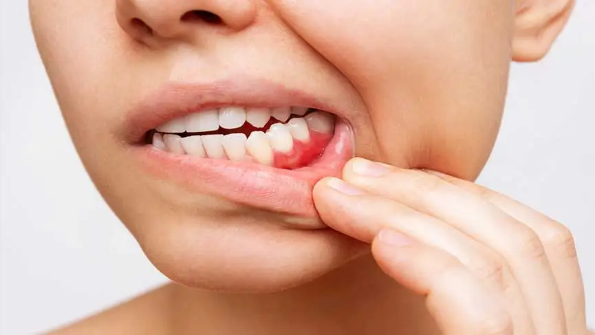 Diş Eti Çekilmesi Nedir? Tedavisi Nasıl Gerçekleşir?